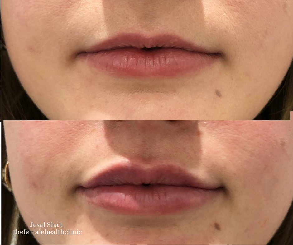 Dermal fillers before and after comparison