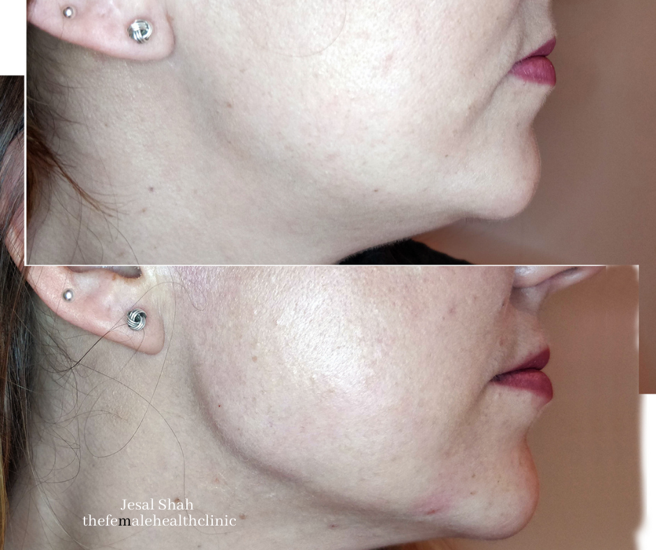 Dermal fillers before and after comparison