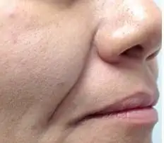 Close up of woman's mouth before