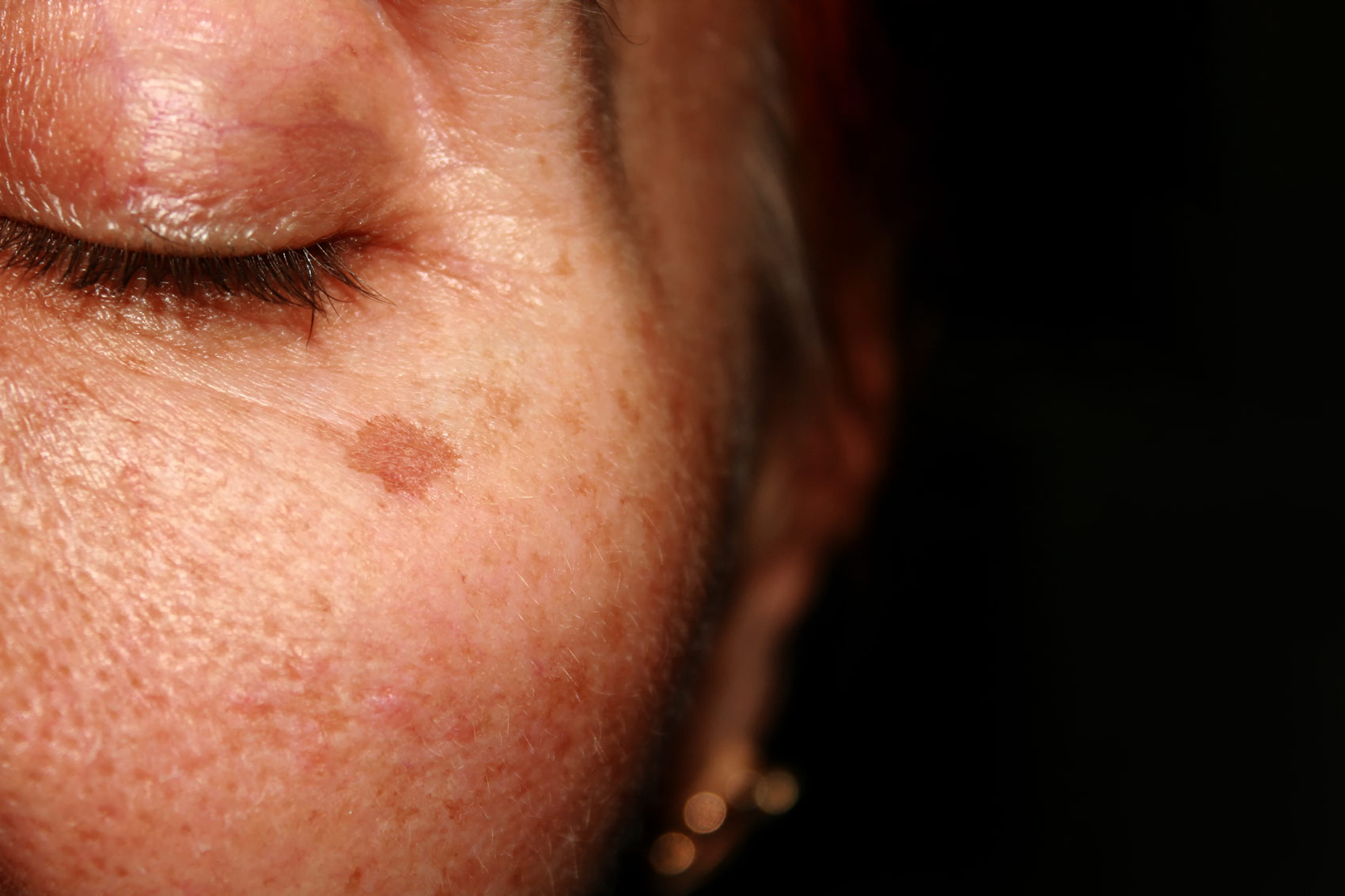 Skin tag on woman's face