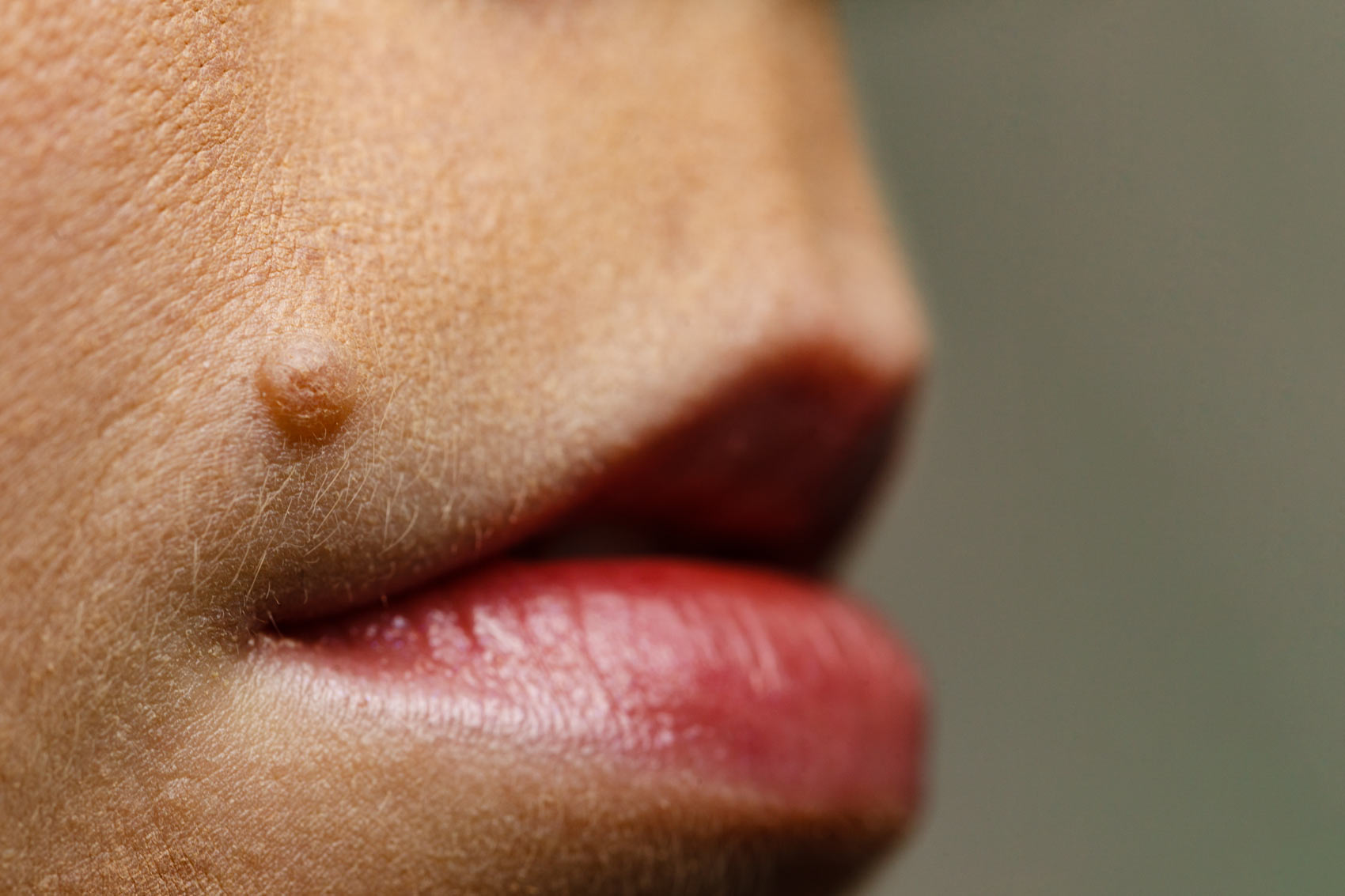 Mole on woman's lip